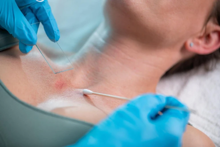 Rimozione dell'ateroma - 2312 - foto 1