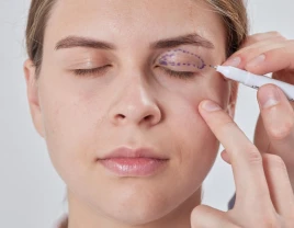 Blepharoplasty of the upper eyelids - 660368 - photo 1 (mini)